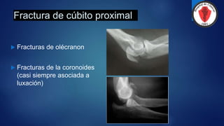 Fractura de cúbito proximal
 Fracturas de olécranon
 Fracturas de la coronoides
(casi siempre asociada a
luxación)
 