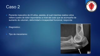 Caso 2
 Paciente masculino de 23 años, pesista, el cual mientras realiza rutina
refiere cuadro de dolor espontáneo a nivel del codo que se acompaña de
aumento de volumen, deformidad e incapacidad funcional, responda:
 Diagnóstico:
 Tipo de mecanismo:
 