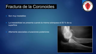 Fractura de la Coronoides
 Son muy inestables
 La inestabilidad se presenta cuando la misma sobrepasa el 50 % de su
superficie
 Altamente asociadas a luxaciones posteriores
 