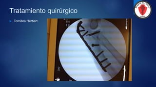 Tratamiento quirúrgico
 Tornillos Herbert
 