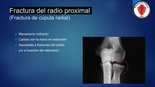 Fractura del radio proximal
(Fractura de cúpula radial)
 Mecanismo indirecto
 Caídas con la mano en extensión
 Asociadas a fracturas del cúbito
 y/o a luxación del olécranon
 