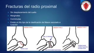 Fracturas del radio proximal
 Sin desplazamiento del cuello
 Marginales
 Conminutas
 Existe un 4to tipo de la clasificación de Mason asociado a
luxación
 