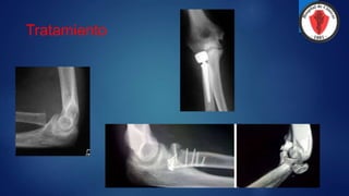 Tratamiento
 