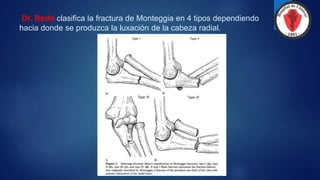 Dr. Bado clasifica la fractura de Monteggia en 4 tipos dependiendo
hacia donde se produzca la luxación de la cabeza radial.
 