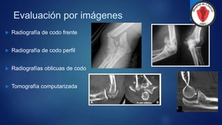 Evaluación por imágenes
 Radiografía de codo frente
 Radiografía de codo perfil
 Radiografías oblicuas de codo
 Tomografía computarizada
 