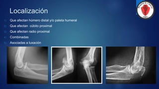 Localización
1) Que afectan húmero distal y/o paleta humeral
2) Que afectan cúbito proximal
3) Que afectan radio proximal
4) Combinadas
5) Asociadas a luxación
 