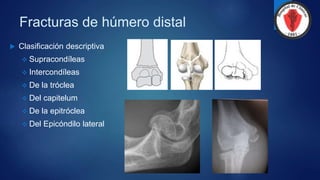 Fracturas de húmero distal
 Clasificación descriptiva
 Supracondíleas
 Intercondíleas
 De la tróclea
 Del capitelum
 De la epitróclea
 Del Epicóndilo lateral
 
