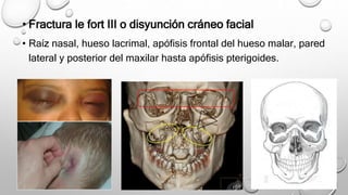 • Fractura le fort III o disyunción cráneo facial
• Raíz nasal, hueso lacrimal, apófisis frontal del hueso malar, pared
lateral y posterior del maxilar hasta apófisis pterigoides.
 