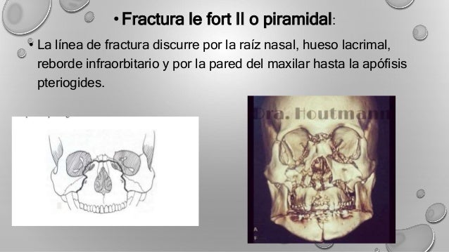 FRACTURAS DE LEFORT PDF DOWNLOAD