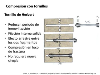 Compresión con tornillos 
Tornillo de Herbert 
• Reducen período de 
inmovilización 
• Fijación interna sólida 
• Efecto arrastre entre 
los dos fragmentos 
• Compresión en foco 
de fractura 
• No requiere nueva 
cirugía 
Green, D., Hotchkiss, R., & Pederson, W. (2007). Green Cirugía de Mano Volumen 1. Madrid: Marbán. Pg.725 
 