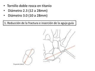 • Tornillo doble rosca en titanio 
• Diámetro 2.3 (12 a 28mm) 
• Diámetro 3.0 (10 a 28mm) 
1. Reducción de la fractura e inserción de la aguja guía 
 