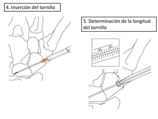 4. Inserción del tornillo 
5. Determinación de la longitud 
del tornillo 
 