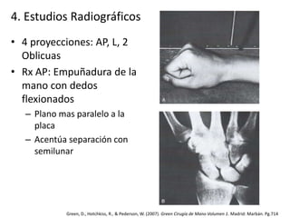 4. Estudios Radiográficos 
• 4 proyecciones: AP, L, 2 
Oblicuas 
• Rx AP: Empuñadura de la 
mano con dedos 
flexionados 
– Plano mas paralelo a la 
placa 
– Acentúa separación con 
semilunar 
Green, D., Hotchkiss, R., & Pederson, W. (2007). Green Cirugía de Mano Volumen 1. Madrid: Marbán. Pg.714 
 