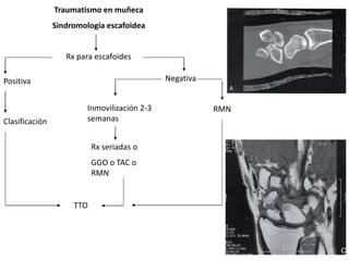 Traumatismo en muñeca 
Sindromología escafoidea 
Rx para escafoides 
Positiva Negativa 
Clasificación 
Inmovilización 2-3 
semanas 
TTO 
Rx seriadas o 
GGO o TAC o 
RMN 
RMN 
 