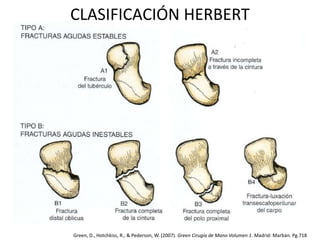 CLASIFICACIÓN HERBERT 
Green, D., Hotchkiss, R., & Pederson, W. (2007). Green Cirugía de Mano Volumen 1. Madrid: Marbán. Pg.718 
 