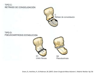 Green, D., Hotchkiss, R., & Pederson, W. (2007). Green Cirugía de Mano Volumen 1. Madrid: Marbán. Pg.718 
 
