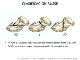 CLASIFICACIÓN RUSSE 
• Fx HO y T: Estables, consolidación con inmovilización entre 6-12 sem 
• Fx VO: Inestables, mayor tiempo requerido de inmovilización 
Green, D., Hotchkiss, R., & Pederson, W. (2007). Green Cirugía de Mano Volumen 1. Madrid: Marbán. Pg.719 
 
