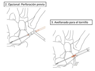 2. Opcional: Perforación previa 
3. Avellanado para el tornillo 
 