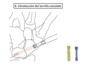 6. Introducción del tornillo canulado 
 
