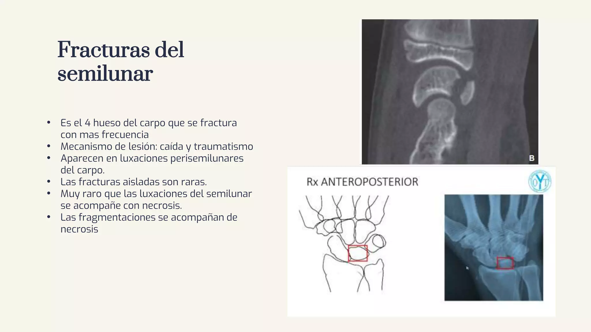 Jsjsjsie FRACTURAS DEL HUESO DEL CARPO (jsjsjs.pptx