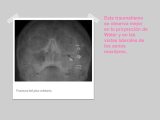 Este traumatismo se observa mejor en la proyección de Wáter y en las vistas laterales de los senos maxilares.Fractura del piso orbitario.