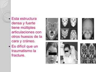 Esta estructura densa y fuerte tiene múltiples articulaciones con otros huesos de la cara y cráneo.Es difícil que un traumatismo la fracture.