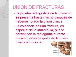 UNION DE FRACTURASLa prueba radiográfica de la unión no se presenta hasta mucho después de haberse notado la unión clínica.La evidencia de una fractura, en especial de la mandíbula, puede persistir en la radiografía durante meses o años después de la unión clínica y funcional.