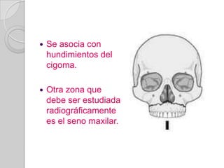 Se asocia con hundimientos del cigoma.Otra zona que debe ser estudiada radiográficamente es el seno maxilar.
