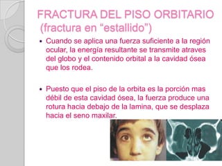 FRACTURA DEL PISO ORBITARIO (fractura en “estallido”)Cuando se aplica una fuerza suficiente a la región ocular, la energía resultante se transmite atraves del globo y el contenido orbital a la cavidad ósea que los rodea. Puesto que el piso de la orbita es la porción mas débil de esta cavidad ósea, la fuerza produce una rotura hacia debajo de la lamina, que se desplaza hacia el seno maxilar.