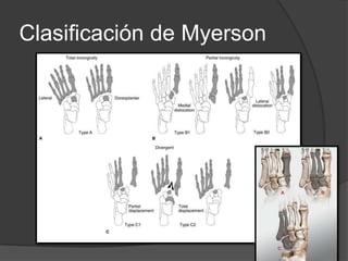 Clasificación de Myerson
 