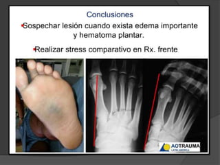 fracturasdelmediopie-131015220304-phpapp01.pdf