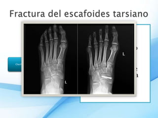 fracturas-del-tarso-metatarso-y-dedos-del-pie-pptx