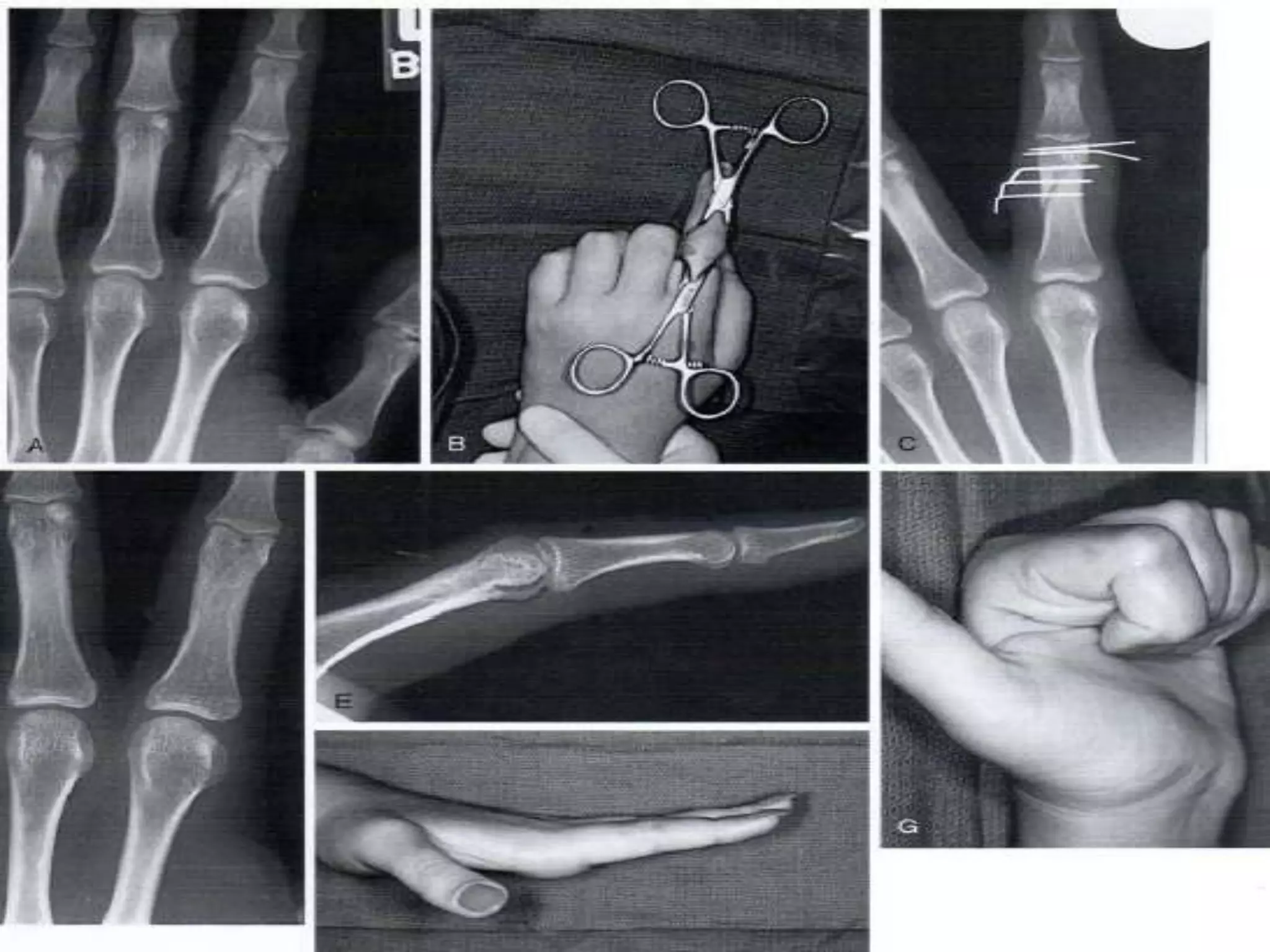 Fracturas de metacarpianos y falanges | PPTX