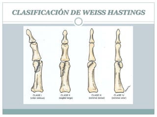 CLASIFICACIÓN DE WEISS HASTINGS
 