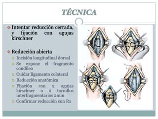 TÉCNICA
 Intentar reducción cerrada,
y fijación con agujas
kirschner
 Reducción abierta
 Incisión longitudinal dorsal
 Se expone el fragmento
condileo
 Cuidar ligamento colateral
 Reducción anatómica
 Fijación con 2 agujas
kirschner o 2 tornillos
interfragmentarios 2mm
 Confirmar reducción con Rx
 