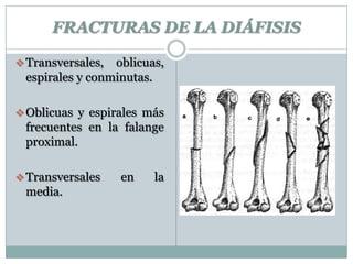 FRACTURAS DE LA DIÁFISIS
Transversales, oblicuas,
espirales y conminutas.
Oblicuas y espirales más
frecuentes en la falange
proximal.
Transversales en la
media.
 