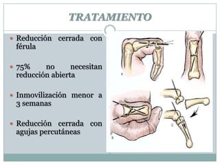 TRATAMIENTO
 Reducción cerrada con
férula
 75% no necesitan
reducción abierta
 Inmovilización menor a
3 semanas
 Reducción cerrada con
agujas percutáneas
 