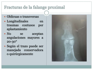 Fracturas de la falange proximal
 Oblicuas o transversas
 Longitudinales en
traumas contusos por
aplastamiento
 No se aceptan
angulaciones mayores a
20-30°
 Según el trazo puede ser
manejada conservadora
o quirúrgicamente
 