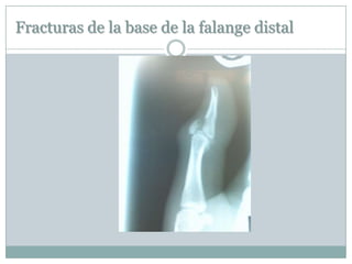Fracturas de la base de la falange distal
 