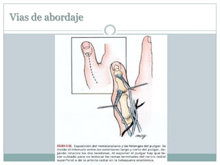 Vias de abordaje
 