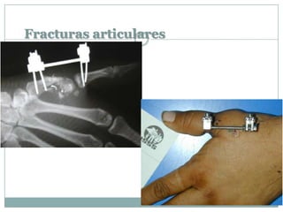 Fracturas articulares
 