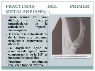 FRACTURAS DEL PRIMER
METACARPIANO
 Puede ocurrir en: base,
diáfisis, y fracturas
intrarticulares de la
articulación trapezio-
metacarpiana
 las fracturas extrarticulares
de la base son comunes,
usualmente transversas u
oblicuas
 La angulación >30° se
acompaña de hiperextensión
compensatoria de la MF, es
inaceptable: inestables
 Fracturas conminutas
requieren fijación externa.
 