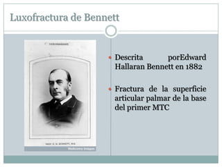 Luxofractura de Bennett
 Descrita porEdward
Hallaran Bennett en 1882
 Fractura de la superficie
articular palmar de la base
del primer MTC
 
