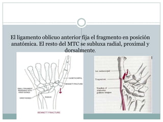 El ligamento oblicuo anterior fija el fragmento en posición
anatómica. El resto del MTC se subluxa radial, proximal y
dorsalmente.
 