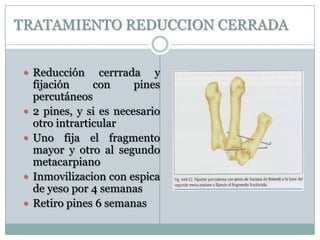 TRATAMIENTO REDUCCION CERRADA
 Reducción cerrrada y
fijación con pines
percutáneos
 2 pines, y si es necesario
otro intrarticular
 Uno fija el fragmento
mayor y otro al segundo
metacarpiano
 Inmovilizacion con espica
de yeso por 4 semanas
 Retiro pines 6 semanas
 