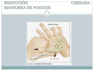 REDUCCIÓN CERRADA
MANIOBRA DE WAGNER
 