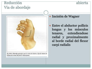 Reducción abierta
Via de abordaje
 Incisión de Wagner
 Entre el abductor pollicis
longus y los músculos
tenares, extendiendose
radial y proximalmente
al borde radial del flexor
carpi radialis
 