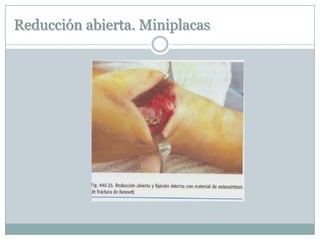 Reducción abierta. Miniplacas
 
