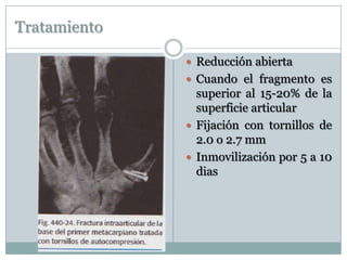 Tratamiento
 Reducción abierta
 Cuando el fragmento es
superior al 15-20% de la
superficie articular
 Fijación con tornillos de
2.0 o 2.7 mm
 Inmovilización por 5 a 10
dias
 