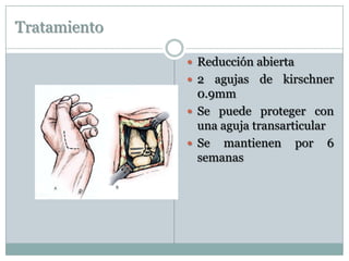 Tratamiento
 Reducción abierta
 2 agujas de kirschner
0.9mm
 Se puede proteger con
una aguja transarticular
 Se mantienen por 6
semanas
 